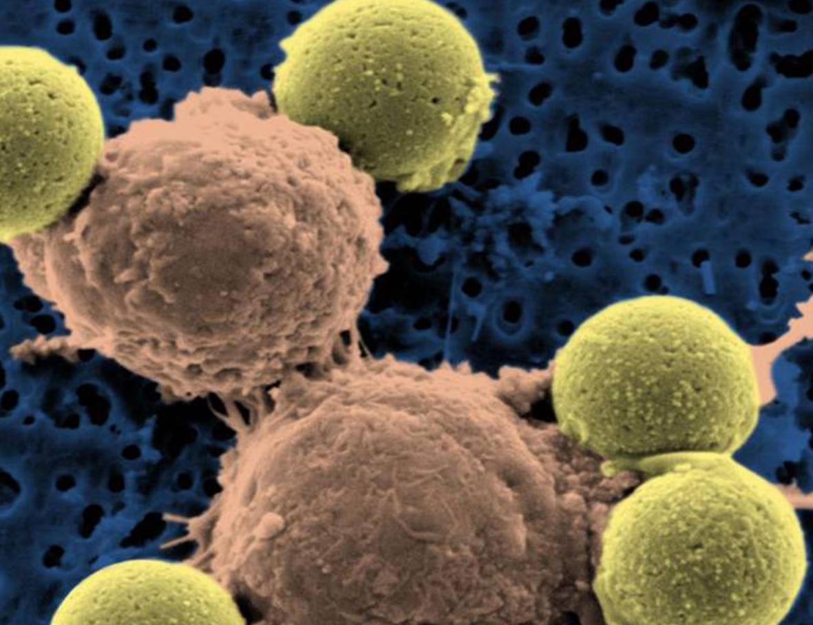 Cancro sconfitto dal vaccino del morbillo in una malata 50enne Cancro sconfitto dal vaccino del morbillo in una malata 50enne