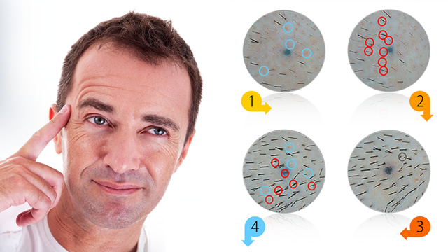 Alopecia: pensi al trapianto di capelli? La soluzione va oltre l'autotrapianto. Alopecia: pensi al trapianto di capelli? La soluzione va oltre l'autotrapianto.