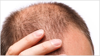 Alopecia il trapianto di capelli non basta: le novità dalla Medicina Rigenerativa Alopecia il trapianto di capelli non basta: le novità dalla Medicina Rigenerativa