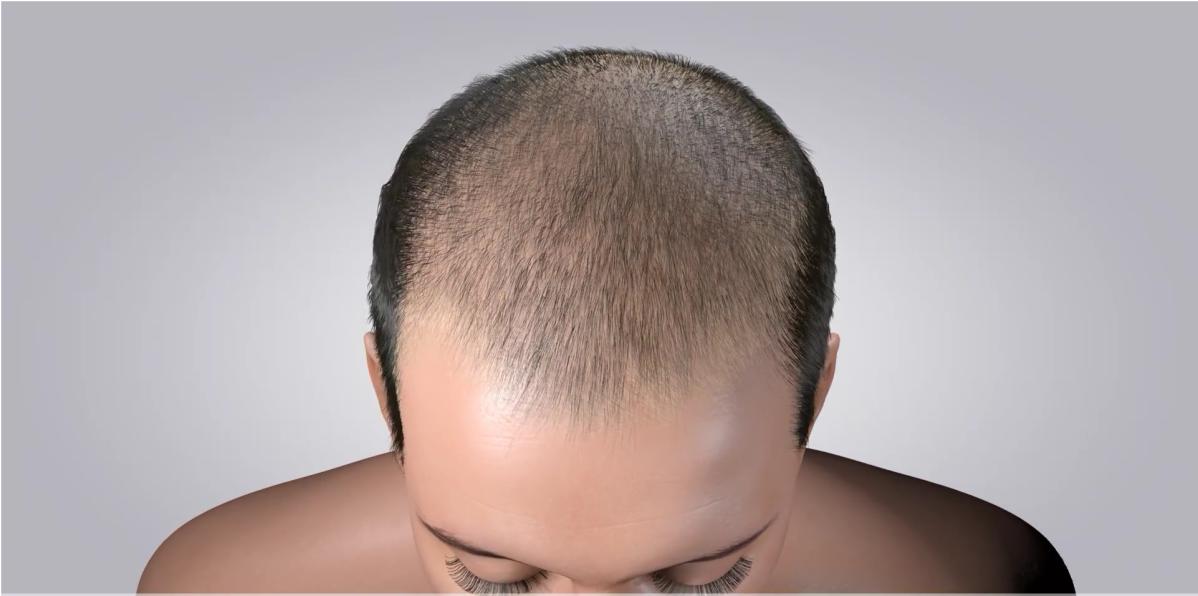 Mezzi per restauro di capelli maschili