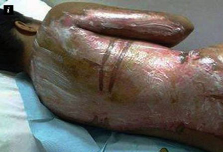 Quello che può esser mangiato dopo operazione di gamba di varicosity